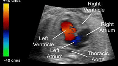 2D Echo color Doppler