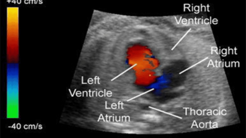 2D Echo color Doppler 2D Echo color Doppler