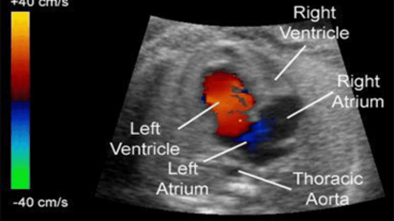 2D Echo color Doppler